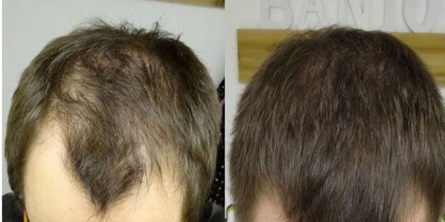 RU58841 Raw Powder RU58841 Raw Powder