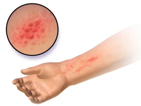 Allergic Reactions Allergic Reactions